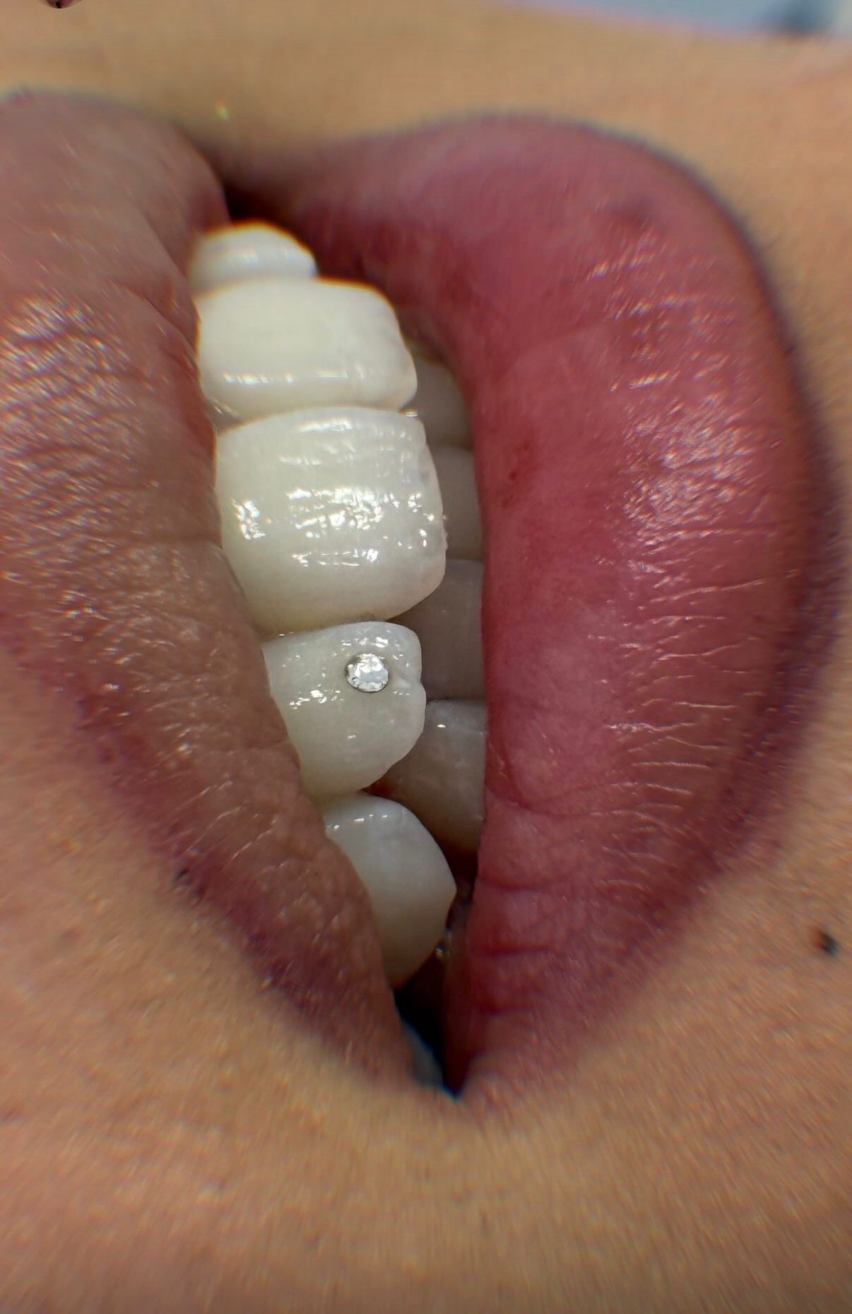 Ein einzelner funkelnder Tooth Gem